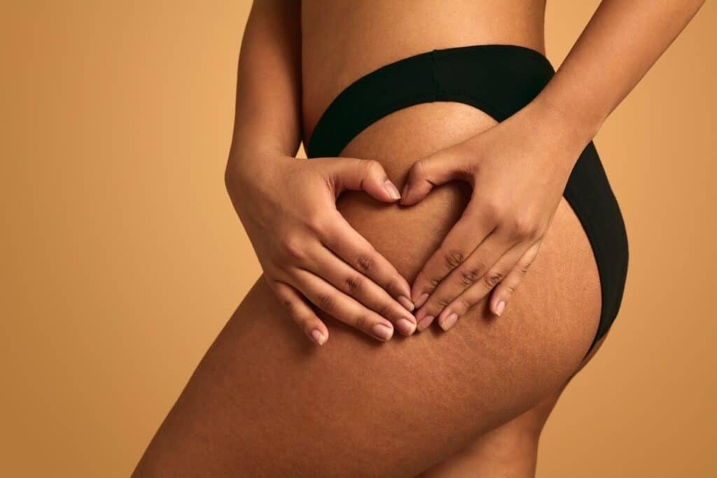 Cellulite and Liposuction