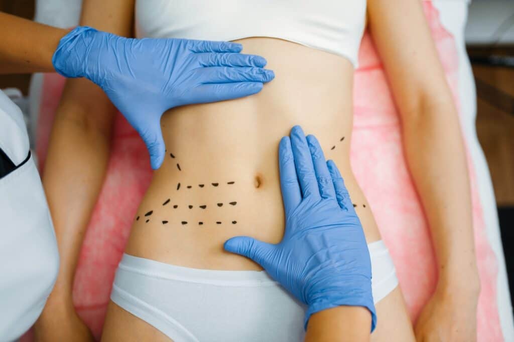 Liposuction Recovery and Aftercare