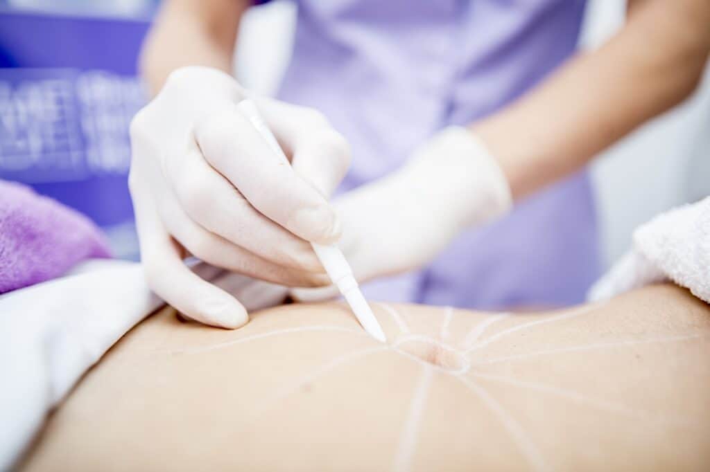 Liposuction Revision