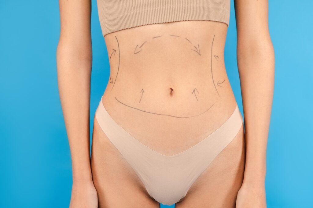 Tummy Luck and Liposuction